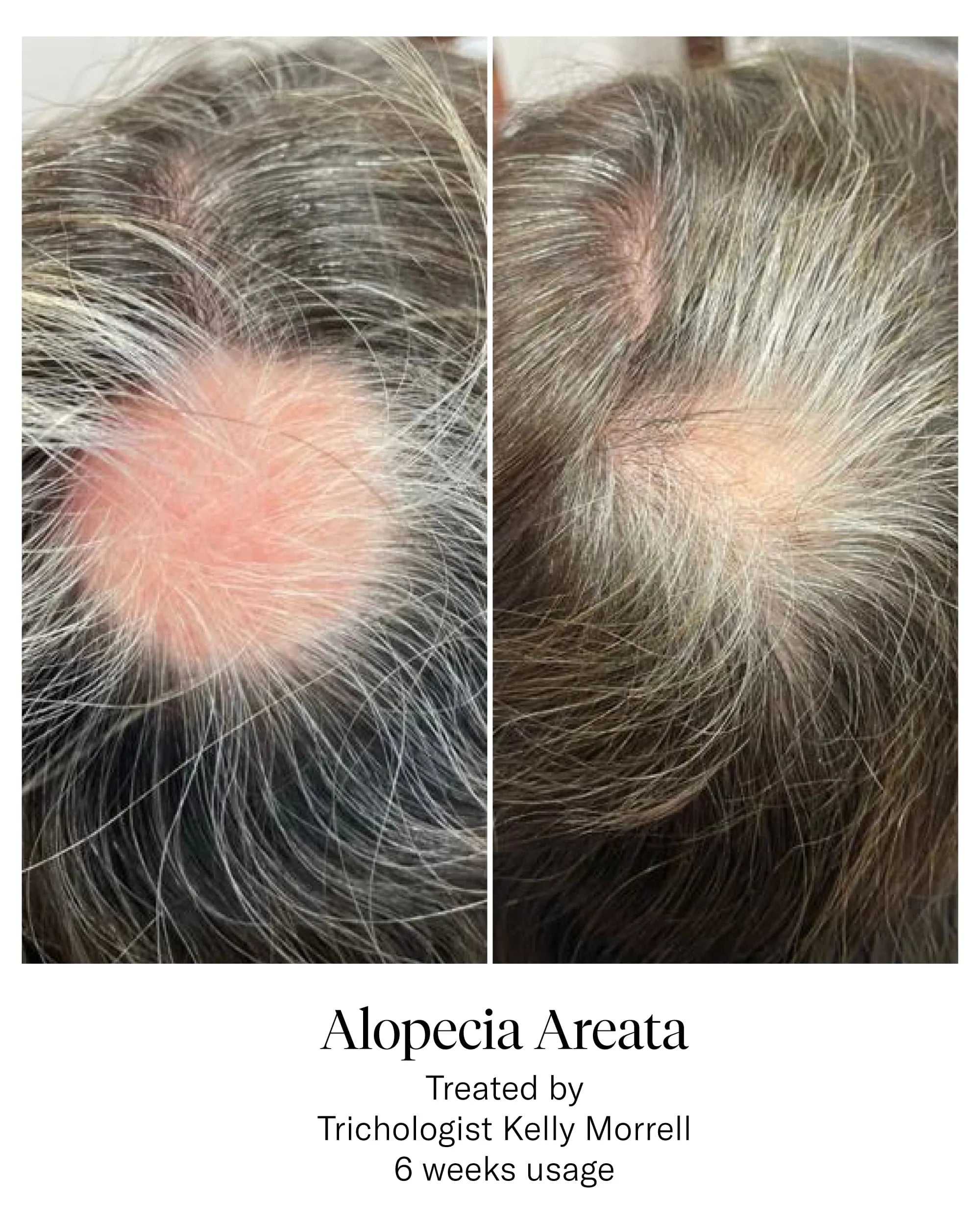 Calecim Hair Restoration Program