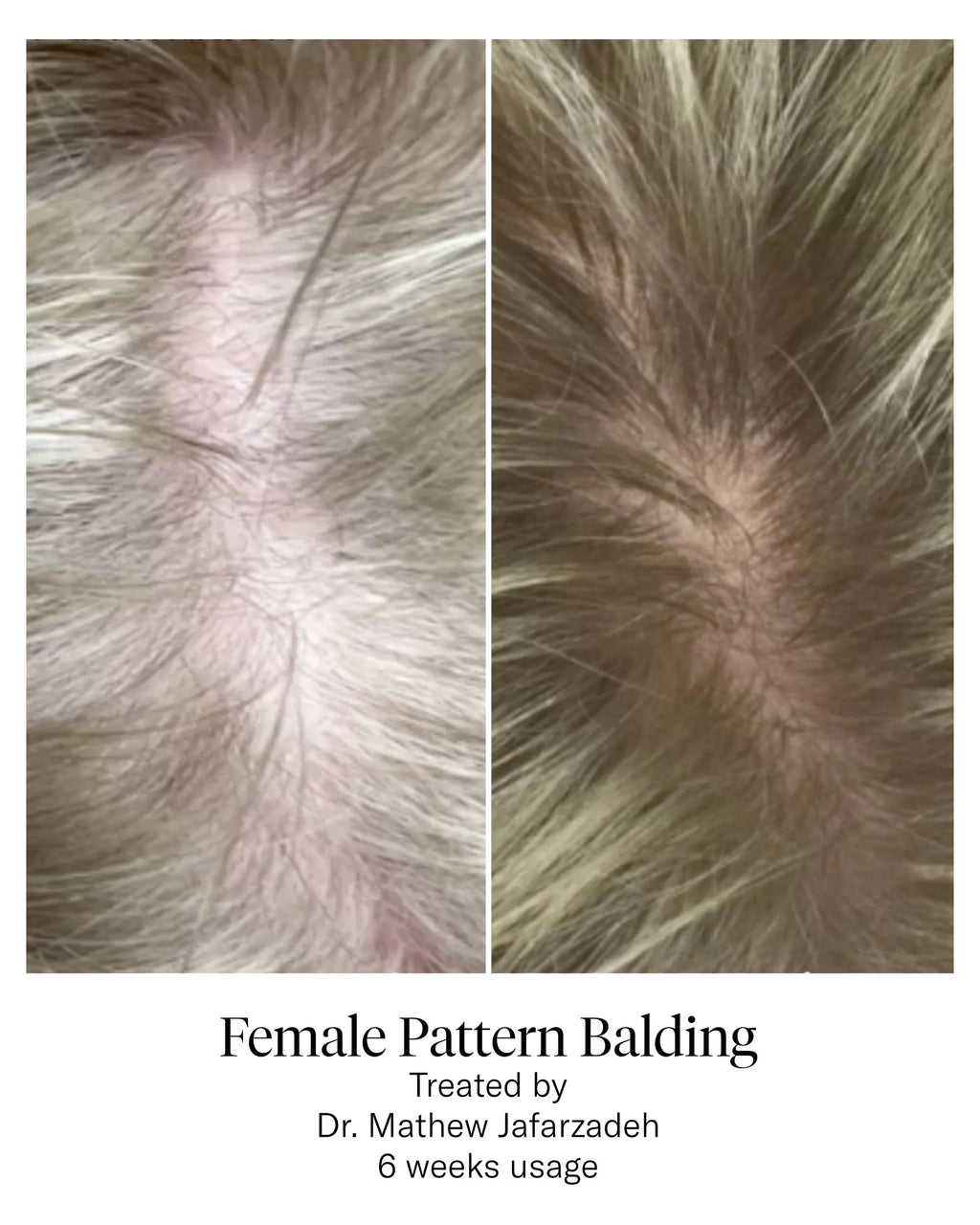 Calecim Hair Restoration Program