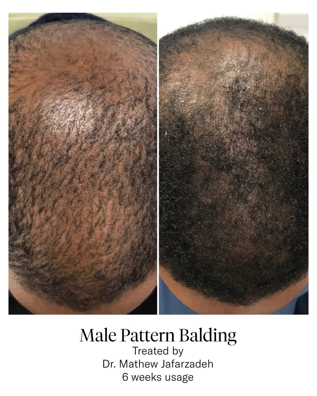Calecim Hair Restoration Program