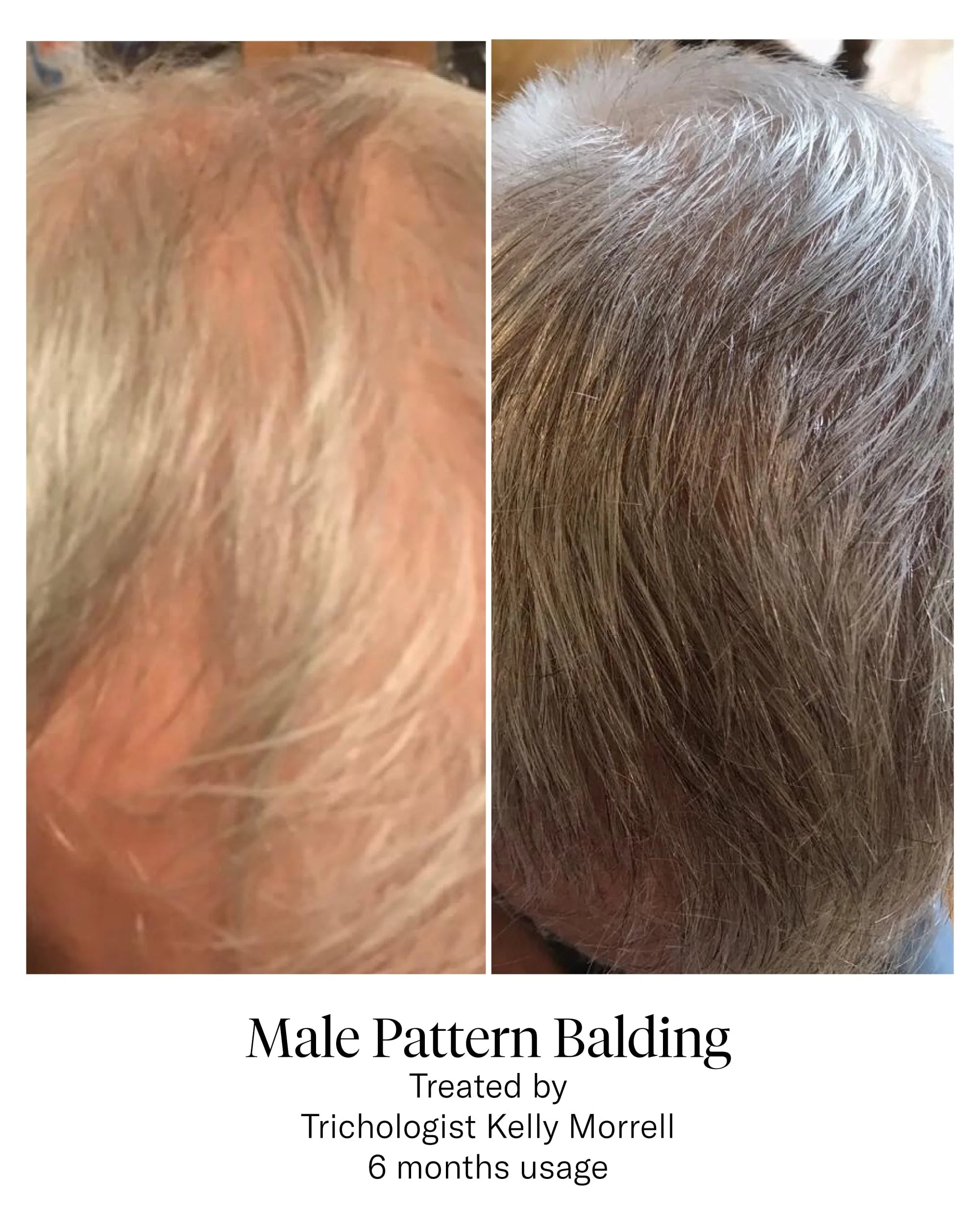 Calecim Hair Restoration Program