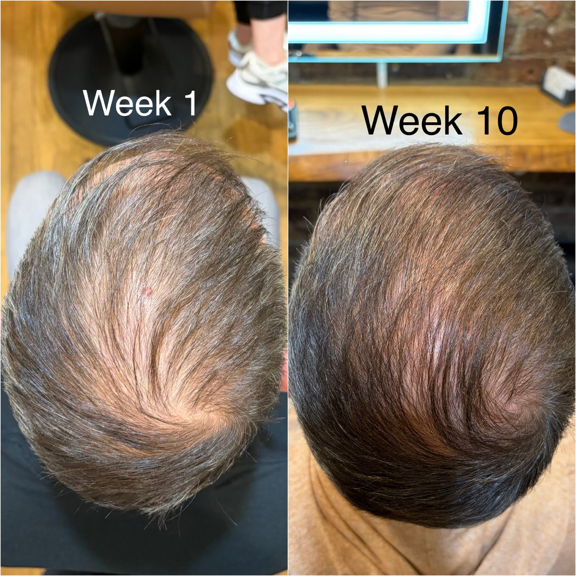 Calecim Hair Restoration Program
